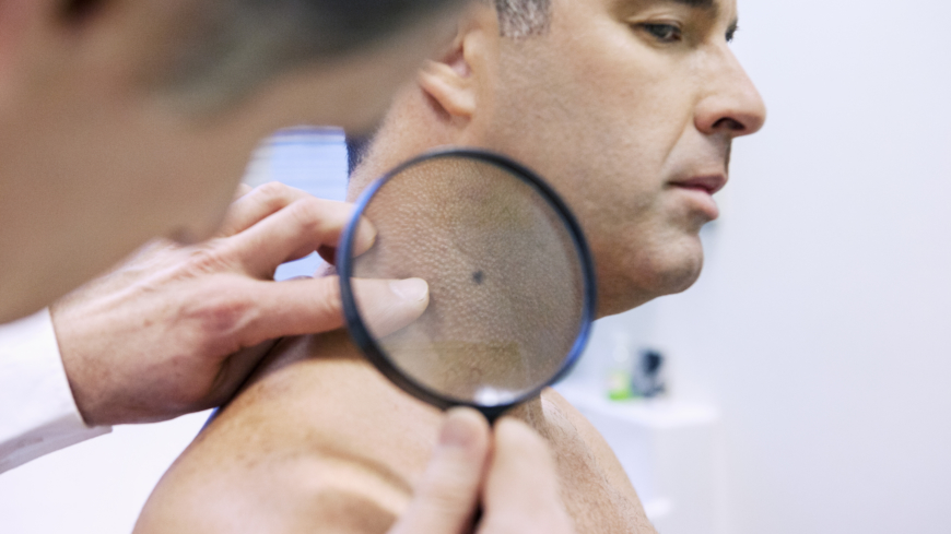 En studie visade att datorprogram och hudläkare var lika bra på att tolka om hudförändringar var farliga eller ofarliga.  Foto: Shutterstock